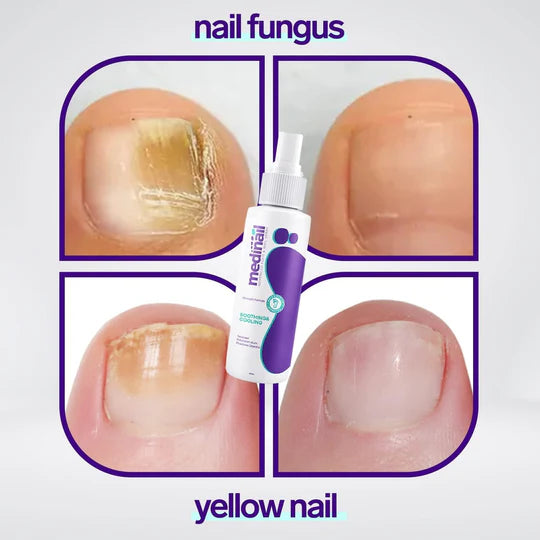 NAIL FUNGUS SPRAY - MEDINAL ELIMINADOR DE HONGOS