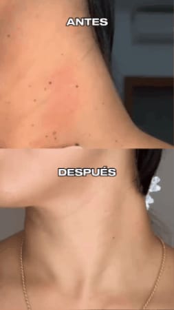 WART REMOVER PLUS - REMOVEDOR DE VERRUGAS 100% ORIGINAL